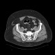 Spiegelian hernia: CT - Computed tomography